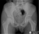 legg-calve-perthes disease